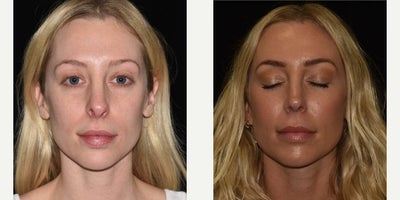 Facial Fat Transfer before and after photo