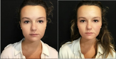 Restylane Lyft before and after photo