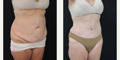 Tummy Tuck before and after photo