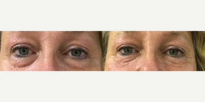 Volbella before and after photo