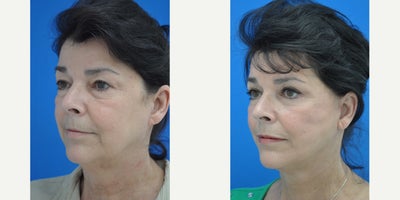 Facelift before and after photo