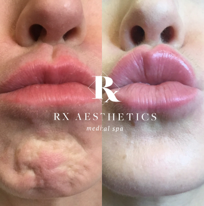Botox before and after photo