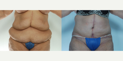 Body Lift before and after photo