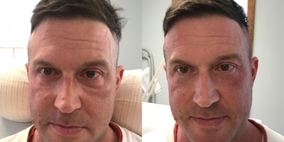 Dermal Fillers before and after photo