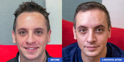 FUE Hair Transplant before and after photo
