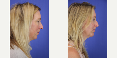 Genioplasty before and after photo