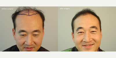 Hair Transplant before and after photo