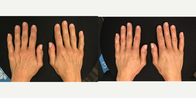 Radiesse before and after photo