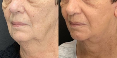 Facelift before and after photo