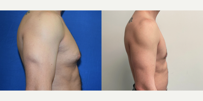 Gynecomastia Surgery before and after photo