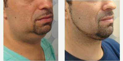 Liposuction before and after photo