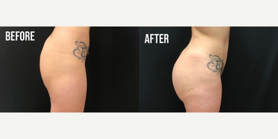 Butt Augmentation before and after photo