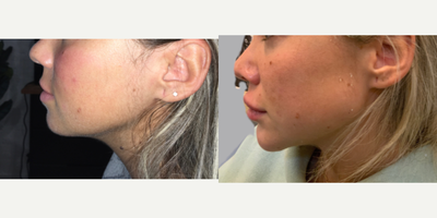 Dermal Fillers before and after photo