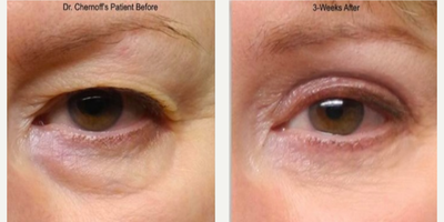 Eyelid Surgery before and after photo