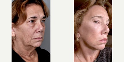 Eyelid Surgery before and after photo