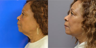 Facelift before and after photo