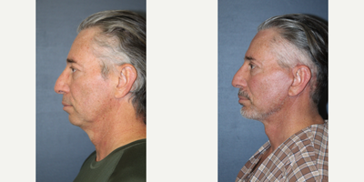 Neck Lift before and after photo