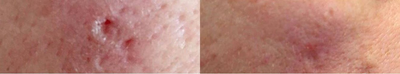 PRP Injections before and after photo
