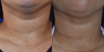Restylane before and after photo