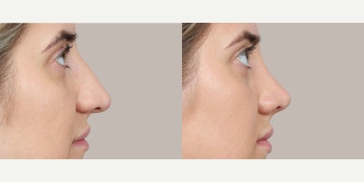 Rhinoplasty before and after photo