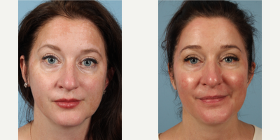 Chemical Peel before and after photo