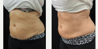 CoolSculpting before and after photo