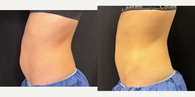 CoolSculpting before and after photo
