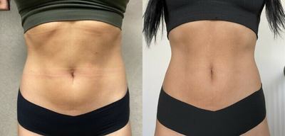 Evolve before and after photo
