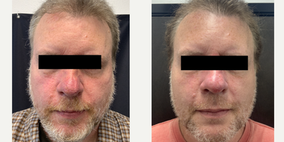 Excel V before and after photo