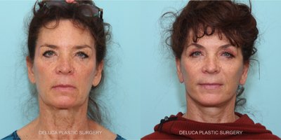 Facelift before and after photo