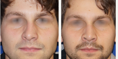 Revision Rhinoplasty before and after photo