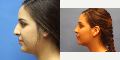 Rhinoplasty before and after photo