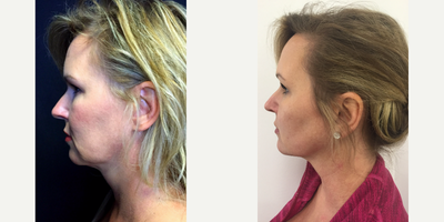 ThermiTight before and after photo