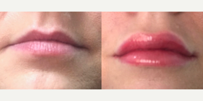Lip Fillers before and after photo
