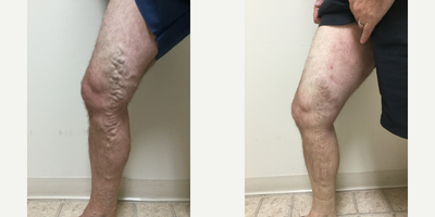 Sclerotherapy before and after photo