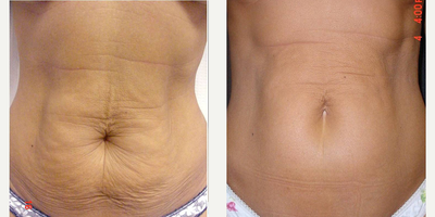 Thermage before and after photo