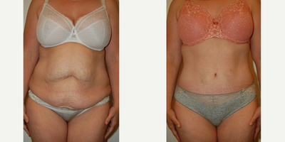 Tummy Tuck before and after photo