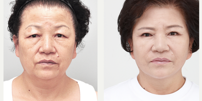 Eyelid Surgery before and after photo
