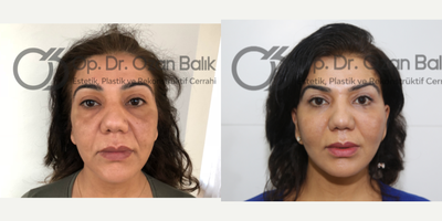Facelift before and after photo