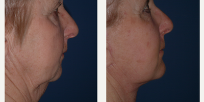 Chin Implant before and after photo