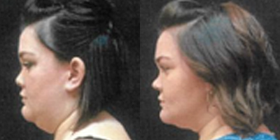 CoolSculpting before and after photo