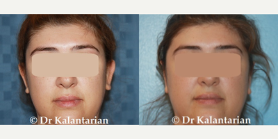 Ear Surgery before and after photo