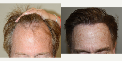 Hair Transplant before and after photo