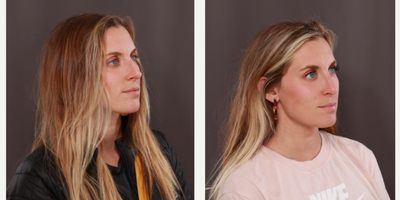Septoplasty before and after photo