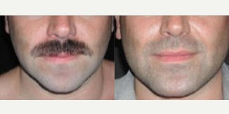 Chin Implant before and after photo