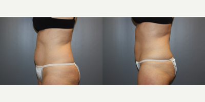 CoolSculpting before and after photo
