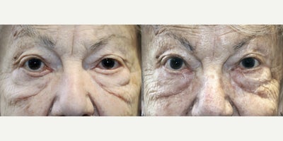 Eyelid Retraction Repair before and after photo