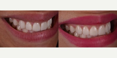 Porcelain Veneers before and after photo