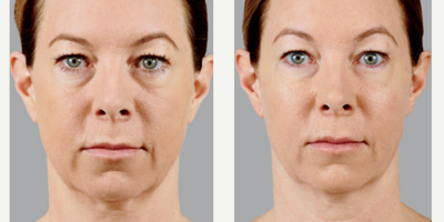 Voluma before and after photo