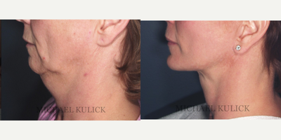 Chin Implant before and after photo